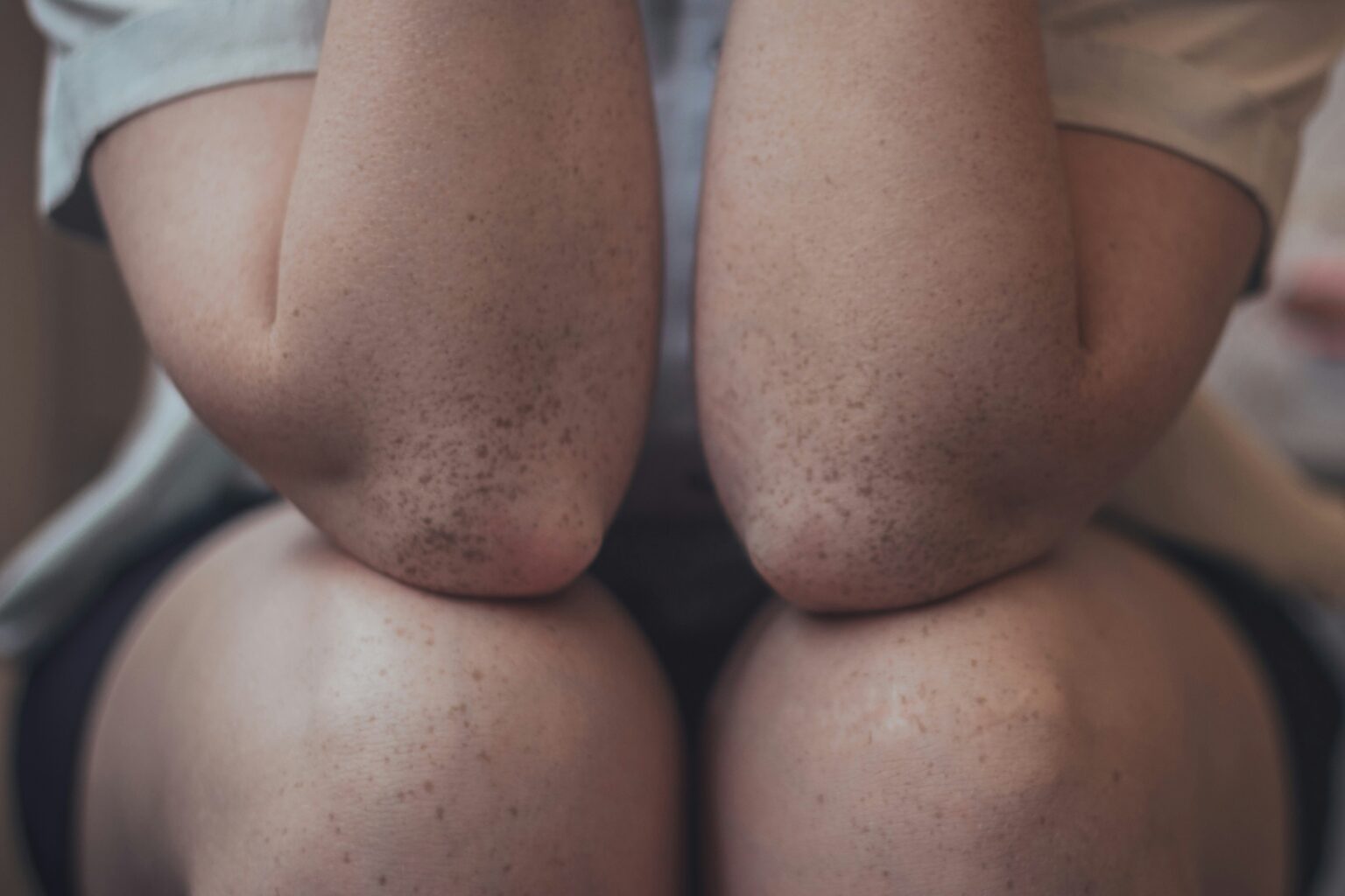 moles-what-are-causes-types-diagnosis-treatment-and-skin-cancers-560589