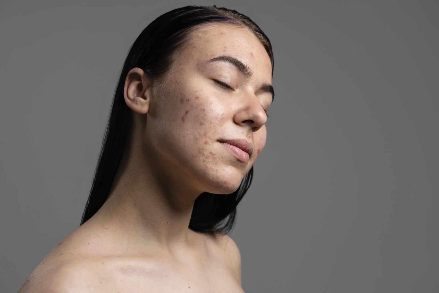 pimples-what-are-types-causes-diagnosis-709429 pimples-what-are-types-causes-diagnosis-709429