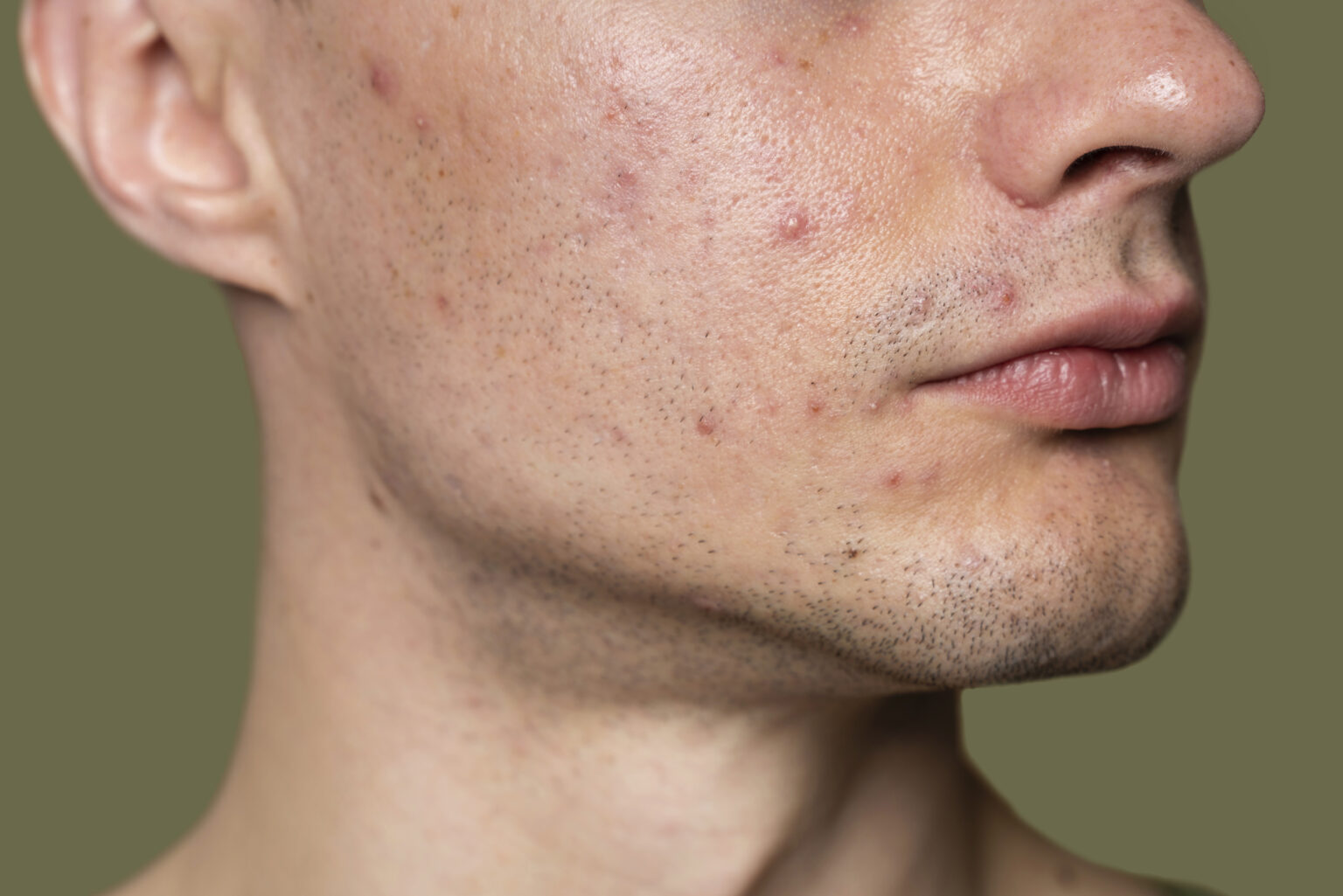 confident-handsome-man-with-acne confident-handsome-man-with-acne