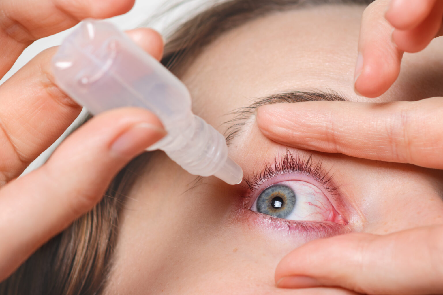 Close up shot of female pours drops in red eye, has conjuctivitis or glaucoma, bad eyesight and pain. Eyes pain treatment concept. Woman cures red blood eye Close up shot of female pours drops in red eye, has conjuctivitis or glaucoma, bad eyesight and pain. Eyes pain treatment concept. Woman cures red blood eye