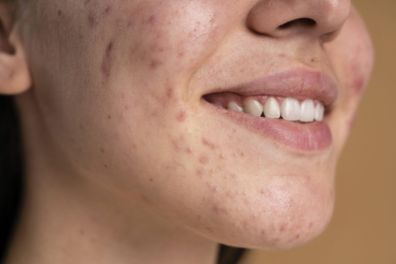 confident-young-woman-with-acne-close-up confident-young-woman-with-acne-close-up